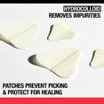 thumbnail image 2 of Neutrogena Stubborn Acne Pimple Patches, Hydrocolloid Patches Acne Treatment, 10 Count, 2 of 6