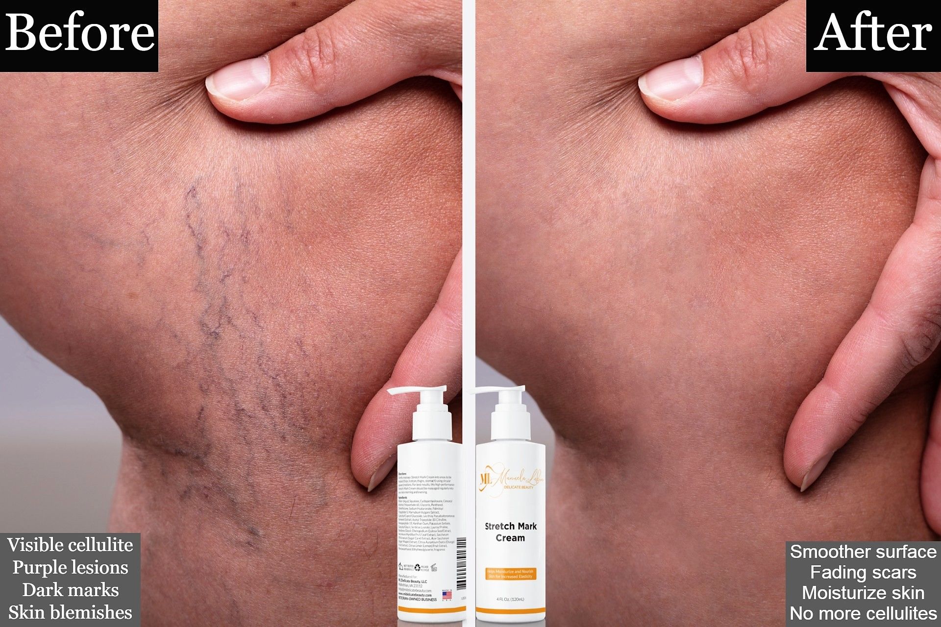 striae cream for stretch marks