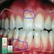 thumbnail image 5 of Reparación rápida de cavidades, Caries, Mousse, Limpieza de dientes, blanqueamiento, eliminación de manchas de placa amarilla, alivia las encías, decaimiento de dientes, pasta de dientes, 5 of 5
