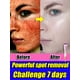 thumbnail image 2 of Crema blanqueadora para pecas, eliminador de Melasma, manchas oscuras, eliminación de melanina, hidratante, ilumina la cara, cuidado de la piel"3pcs" Fivean LED, 2 of 2