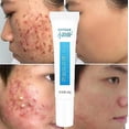 thumbnail image 1 of 1/2/3 Uds Crema para el acné con ácido azelaico elimina acné espinillas blanquea las manchas oscuras cicatrices tratamiento antiacné Gel reduce los poros Control de aceite cuidad, 1 of 4