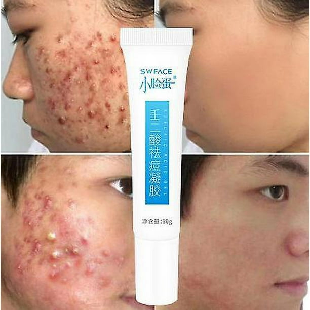 1/2/3 Uds Crema para el acné con ácido azelaico elimina acné espinillas blanquea las manchas oscuras cicatrices tratamiento antiacné Gel reduce los poros Control de aceite cuidado facial 10g