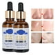 thumbnail image 4 of Tratamiento Del Acné, 2 Botellas De Suero Para Eliminar Espinillas, Seguro De Usar, Natural Para La Vida Diaria, 4 of 7