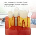 thumbnail image 3 of Modelo De Implante Dental, Resina De Modelo De Dientes De Implante Seguro Para Educación, 3 of 7
