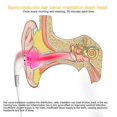 thumbnail image 3 of 2024 Tinnitus Terapia con láser de oído LLLT Irradiación Láser Fisioterapia Tapón para los oídos Otitis, 3 of 4