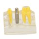 thumbnail image 1 of Modelo de Diente de Implante JadeshayMX Transparente Para Estudio Dental, 1 of 5