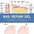thumbnail image 5 of 3pcs Anti-Fungal Nail Treatment Gel Nail Care Gel Nail Thickening Brightening Onychomycosis Repair Cream, 5 of 5