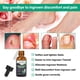 thumbnail image 3 of Kit de tratamiento para uñas encarnadas YOUVLAN con gotas suavizantes, 3 of 7