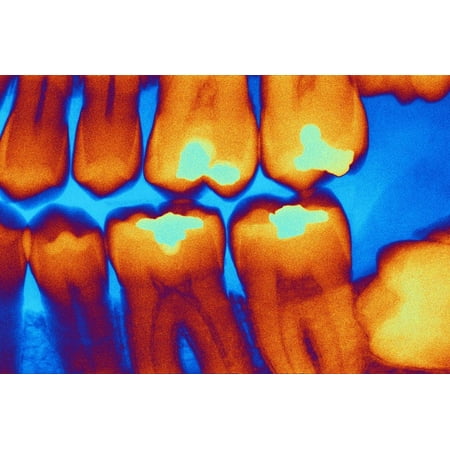 Teeth with Fillings, X-ray Print Wall Art By