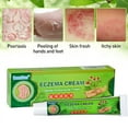 2 Pack Eczema Lotion for dry itchy skin Rosacea treatment Face Rash