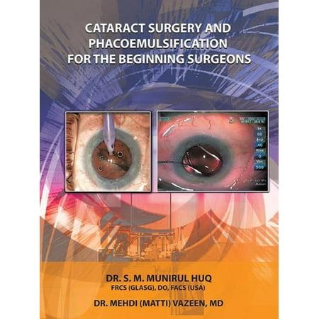 Cataract Surgery and Phacoemulsification for the Beginning Surgeons -