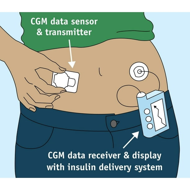 Continuous Glucose Monitor Poster Print by Science Source