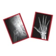 thumbnail image 3 of Roylco Fixed Bone X-Rays – Educational Human Anatomy X-Ray Set with Authentic Images of Bone Repair, STEM/STEAM Learning, Medical Science Exploration & Light Table Study, 3 of 5