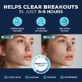 thumbnail image 4 of Parche hidrocoloide para acné Pimple Patches Duracleanse, 134 unidades, 4 of 6