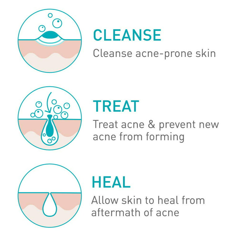 CeraVe Acne Skin Care Set, 5oz Acne Foaming Cream Cleanser +  1oz Resurfacing Retinol Serum + 2oz AM Facial Moisturizing Lotion with SPF  30 + 2oz PM Facial Moisturizing Lotion