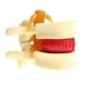 thumbnail image 5 of Nuevo o De Protrusión D Intervertebral De Zulema Estatua de protrusión del disco lumbar, 5 of 7
