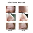 thumbnail image 3 of Electric Blackhead Suction Device with 5 in 1 Pimple Zit Comedone Extractor Tool Acne Removal, 3 of 8