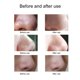 thumbnail image 4 of 【Con video】Limpiador facial eléctrico para puntos negros, 3 velocidades, 5 cabezales de succión, limpieza profunda de poros, batería recargable, fácil de usar en casa., 4 of 7