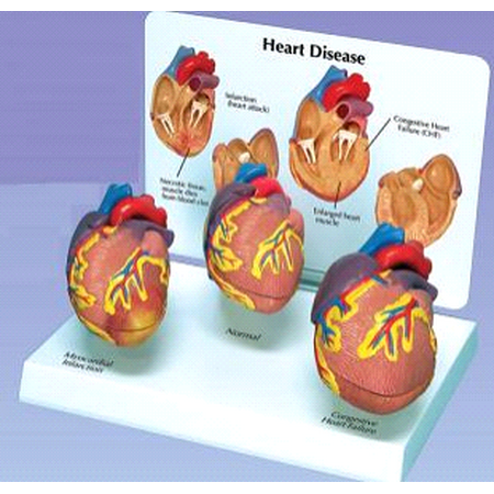 Anatomical 3 Mini Heart Disease Set Model #2550
