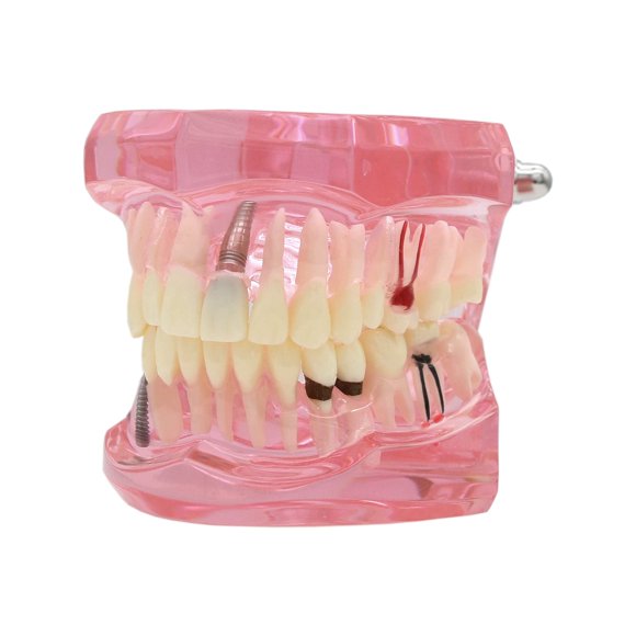 Dentalmall Modèle de Dents Typodontes Analyse d'Itraits Dentaires Démonstration Modèle de Dents 2001 avec Restauration Rose