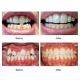 thumbnail image 3 of Orthodontic Braces Dental Braces Smile Teeth Alignment Trainer Instanted Silicone Teeth Retainer Mouth Guard Braces Tooth Tray, 3 of 4