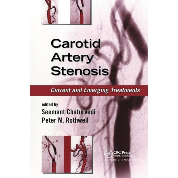 Carotid Artery Stenosis: Current and Emerging Treatments, (Paperback)