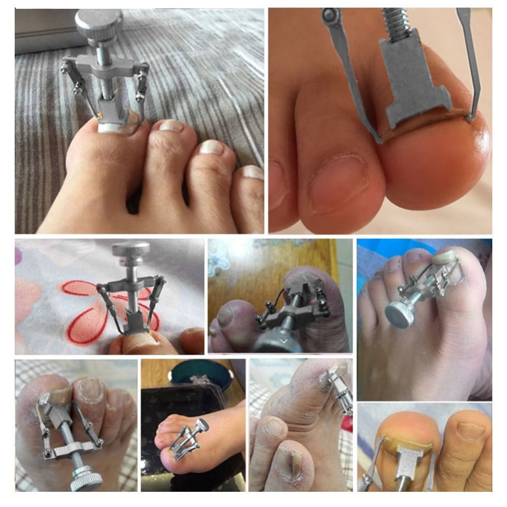 Mnycxen Ingrown Toe Nail Recover Correction Tool Pedicure Toenail Fixer