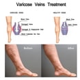 thumbnail image 5 of Tratamiento de venas Spray de tratamiento de venas varicosas, Tratamiento de venas Spray de tratamiento de venas varicosas, Tratamiento de venas varicosas de piernas kaili Sencillez, 5 of 5