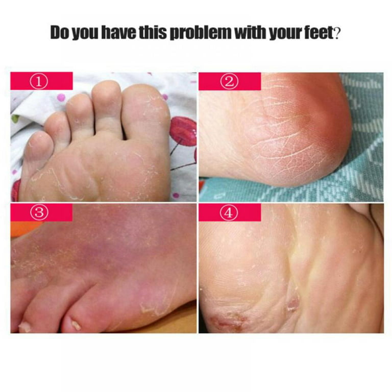 Foot File Callus Remover Feet Rasp for Dead Skin Foot Scrubber for Feet 6 Pcs - 6pcs White Collar Blue