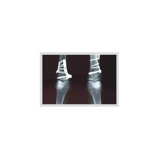 Fixed Tibia X Ray Print Canvas Giclee 12x18 Walmart Com Walmart Com
