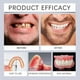 thumbnail image 2 of Advanced Customized Full Denture Set Silicone Reline), 2 of 5