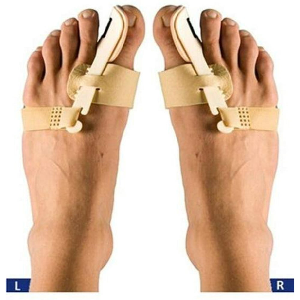 Вальгус без операции. Вальгус косточка на большом пальце. Лечебная мазь от вальгусной деформации. Вальгус без операции. Вальгус без операции.