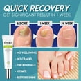 MNIYUEA Skin Care Products Gel Toe Removal Nail Feet Care Nail Personal