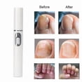 thumbnail image 4 of Anti-fungal Home Kit Blue Laser Pointer Onychomycosis Painless Nail Repair, 4 of 4