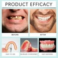 thumbnail image 4 of Minceetbien Dentures, Silicone Reline Denture Set, Denture Reline Kit Is Suitable for Securing Upper and Lower Dentures, 100% Soft Silicone, Flexible & Easy-to-Use (2 pcs), 4 of 7