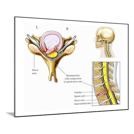 Illustration of Cervical Disc Herniation with Spinal Cord and Nerve Root Impingement Wood Mounted Print Wall Art By Nucleus Medical