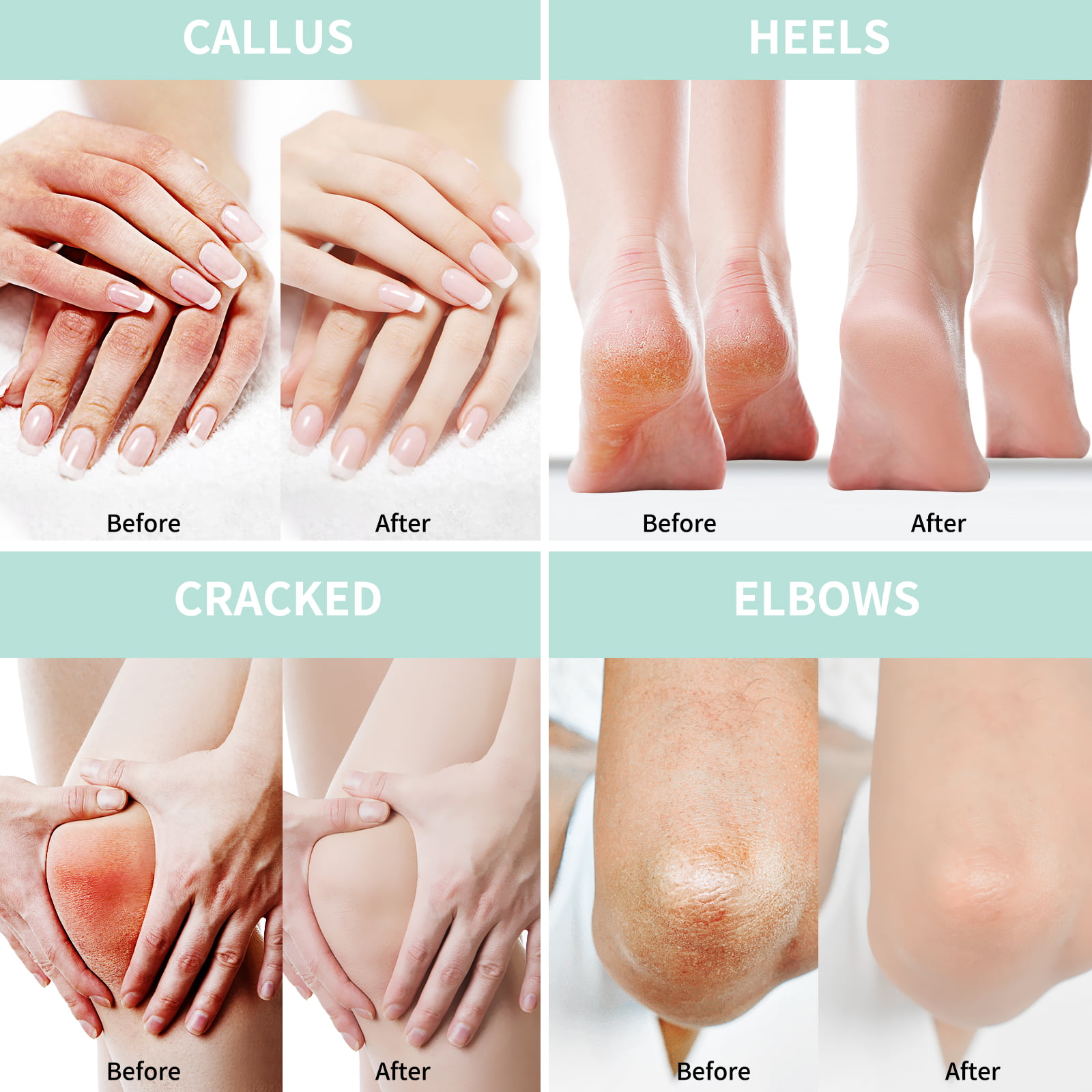 Urea Cream 40% Plus Salicylic Acid 4.6 Oz, Callus Remover Hand Cream Foot  Cream For Dry Cracked Feet, Hands, Heels, Elbows, Nails, Knees, Intensive  Moisturizes & Softens Skin, Exfoliates Dead Skin - Walmart.com