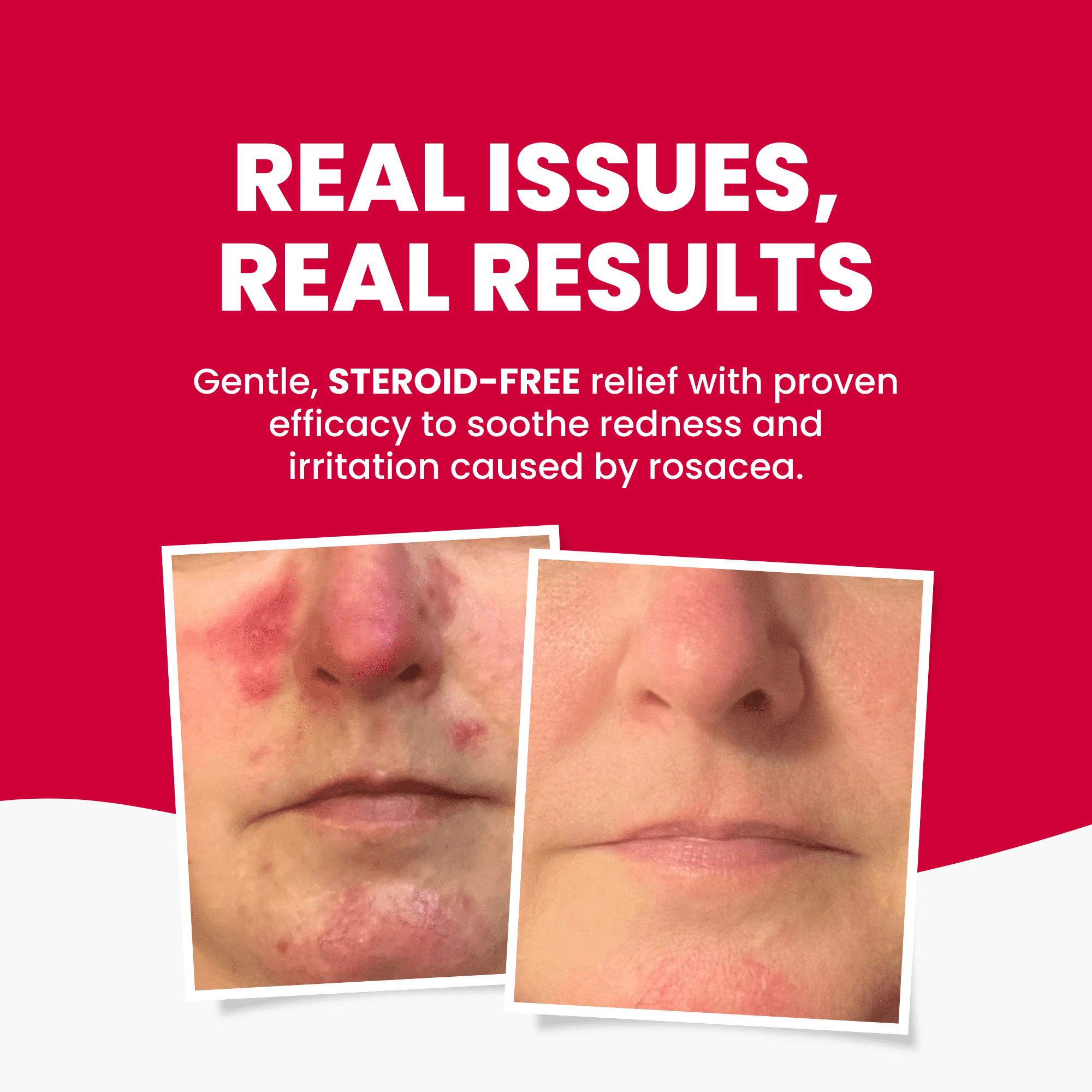 Grahams Natural Rosacea Cream, Natural Anti-Redness Moisturizer (75g Tube)