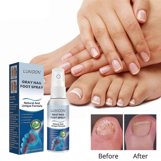 Antifungals Nail Treatments Spray In Medicals Quality, 30 Ml, Antifungals Nail Treatments, Antifungals Spray 30ml 20231120