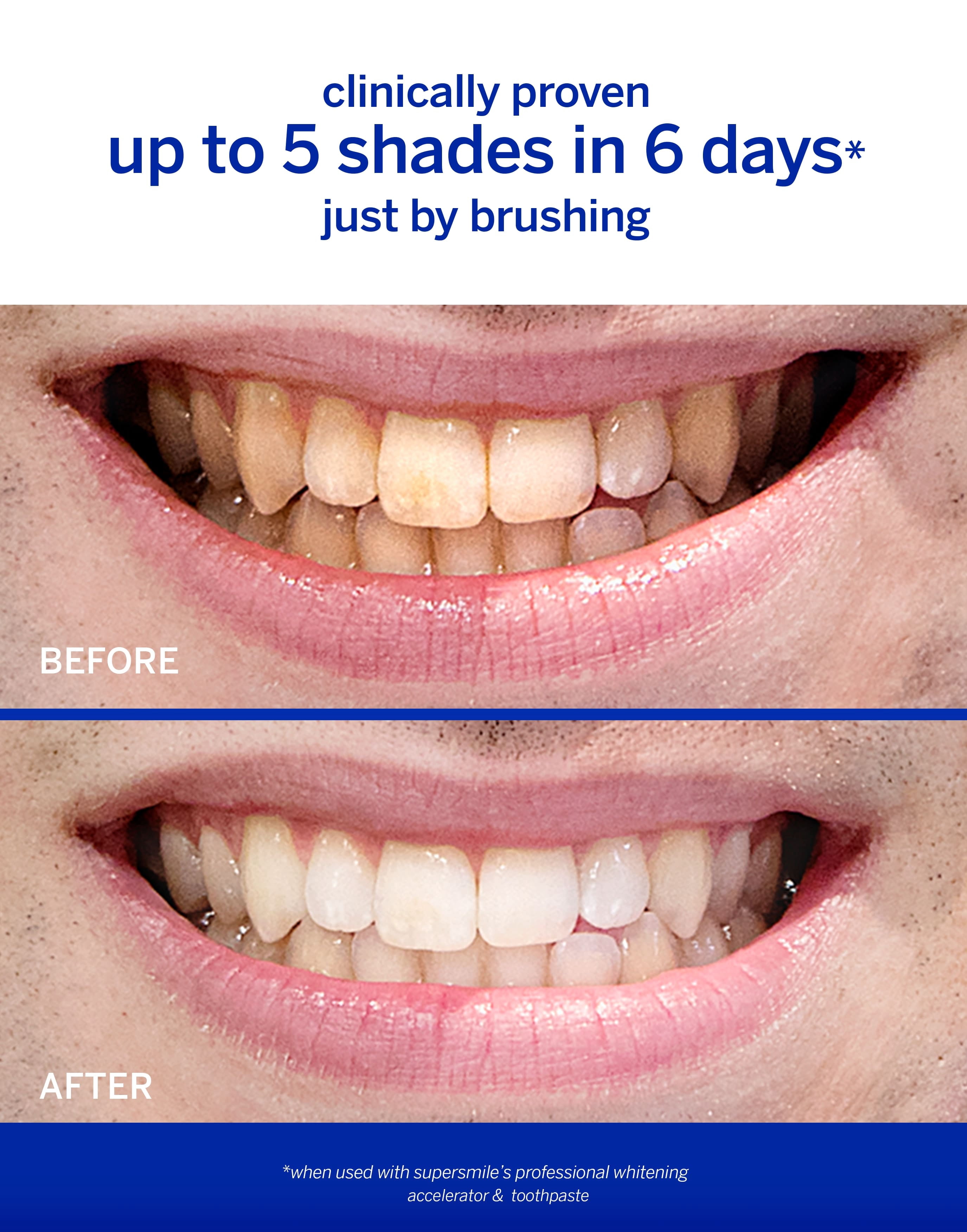 Supersmile Professional Teeth Whitening System with Whitening Toothpaste and Accelerator