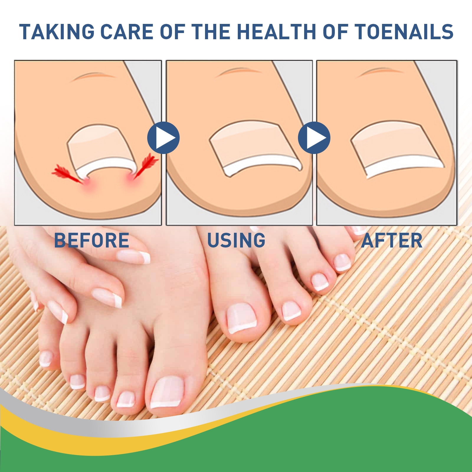 Alvantor Ingrown Toenail Treatment, Breathable Ingrown Toenail Corrector Patches