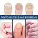 thumbnail image 4 of EELHOE toenail care patch, gray nail care patch, soft toenail, embedded nail, thickened bright nail groove care patch, 4 of 5