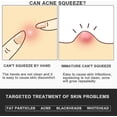 thumbnail image 5 of Professional Facial Milia Removal And Whitehead Extractor & Lancet - Double Ended Circle Loop & Sharp Needle Pimple Tool - 2-in-1 Blackhead & Blemish, 5 of 5