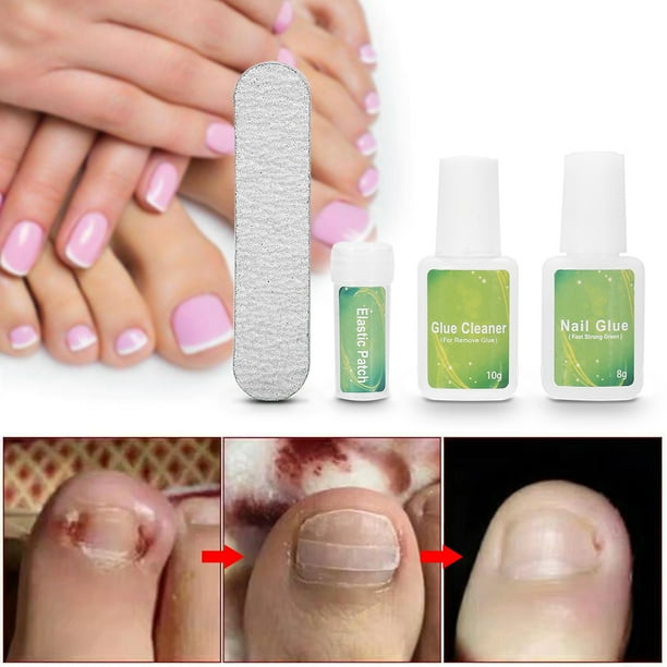 Juego De Herramientas De Pedicura Profesional Encarnadas, Recortador De Uñas De Los Pies, Fijador De Corrección De Uñas Encarnadas, Cuidado De Los Pies
