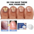 thumbnail image 4 of Fungus Laser Therapy Device, Light Therapy Device Fungal Nail, Revolutionary High-efficiency Light Therapy Device For Toenail Diseases -gsl, 4 of 5