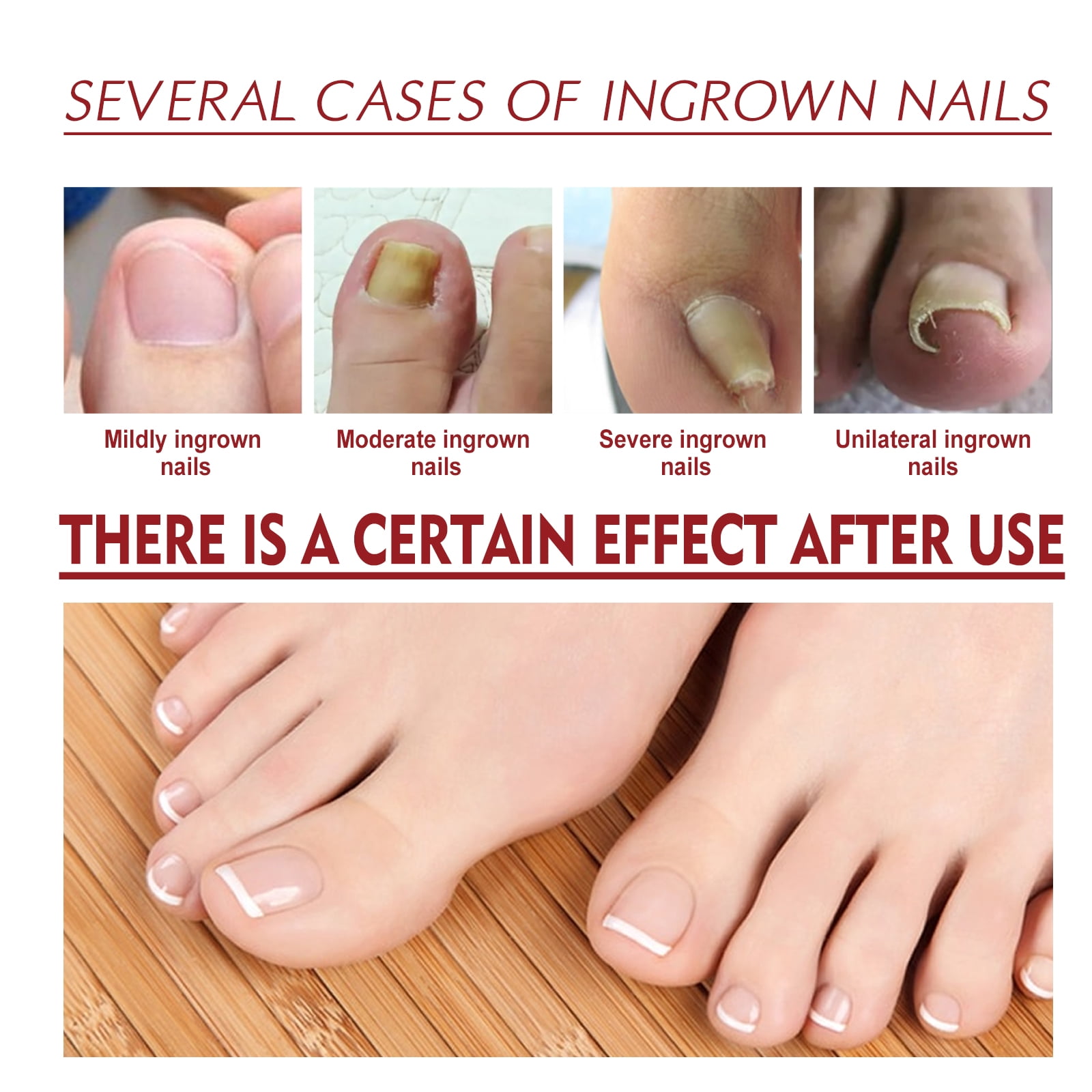 Alvantor Ingrown Toenail Treatment, Pain Relief and Nail Care for Ingrown Corrector and Fungus Treatment, 0.34fl.oz