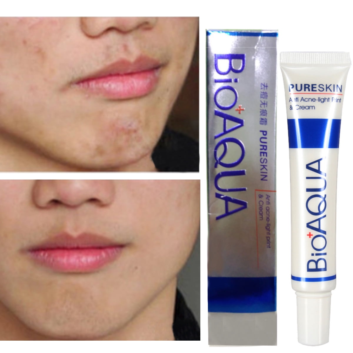 fordyce spots removal cream