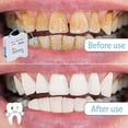 thumbnail image 5 of Tooth Polisher Abrasive Strip - Dental File for Teeth Finishing & Polishing, 4mm x 6M, 5 of 5