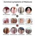 thumbnail image 4 of 1/2/3Pcs Nail Fungal Treatment Feet Care Essence Nail Foot Care Toe Nail Fungus Removal Gel Anti Infection Paronychia Onychomycosis, 4 of 5
