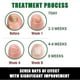 thumbnail image 4 of 7 Days Nail Fungus Treatment, Jaysuing 7 Days Nail Fungus Treatment, Ginger Nail Fungus Treatment_c*, 4 of 5